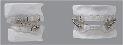 High-Resolution Pulse Oximetry and Titration of a Mandibular Advancement Device for Obstructive Sleep Apnea